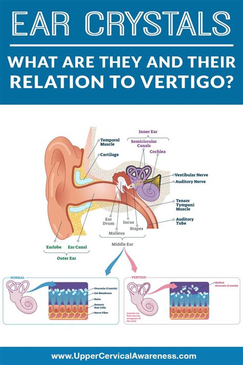 Typically in clinic, it only takes 1 to 3 sessions to completely get rid of Vertigo from BPPV. . Crystals in ear symptoms